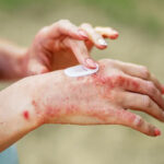 KP Confirms First Dengue Death of 2025 in Mardan